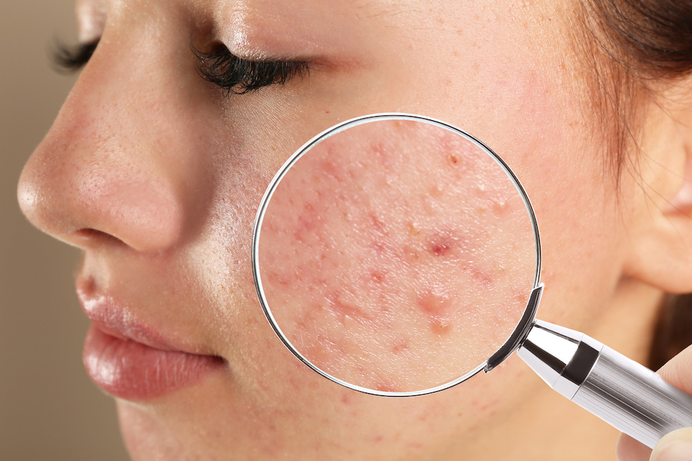 acne in face